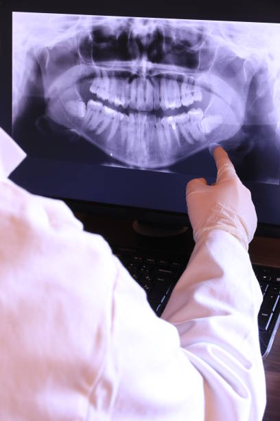 Best Knocked-Out Tooth (Avulsed Tooth) Treatment in Endicott, NY