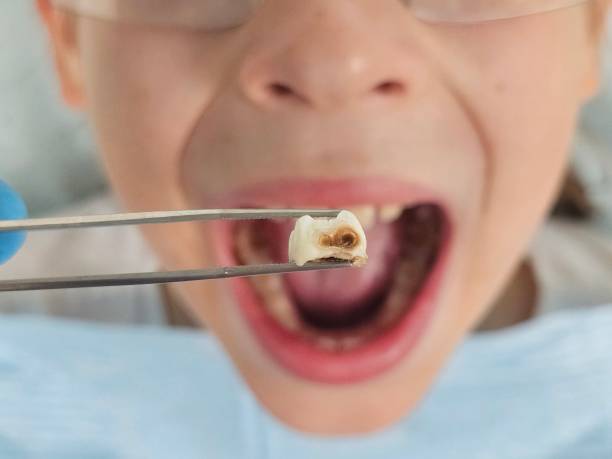 Best Dental Abscess Treatment in Endicott, NY